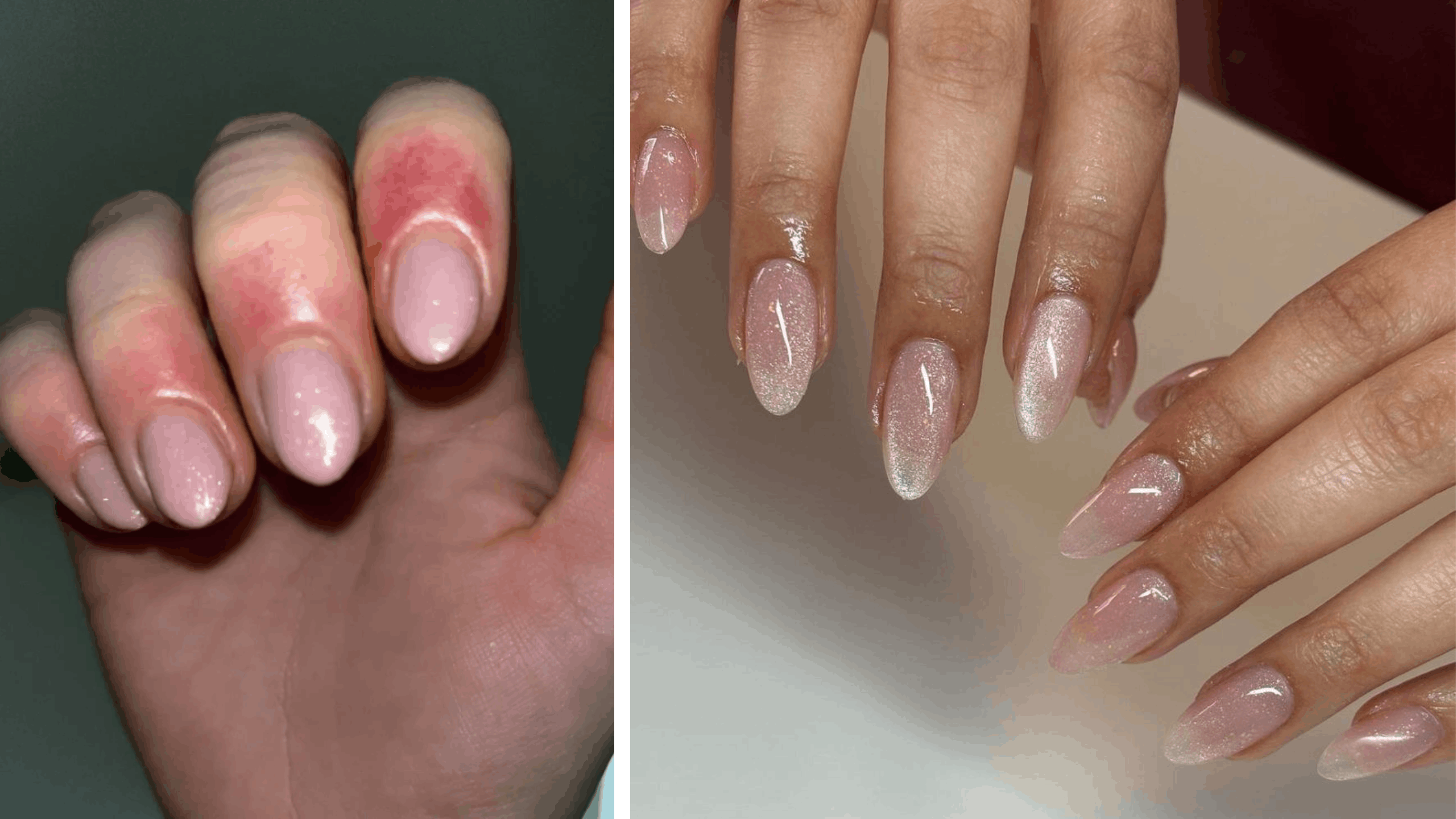 réaction allergique au vernis à ongles semi-permanent
