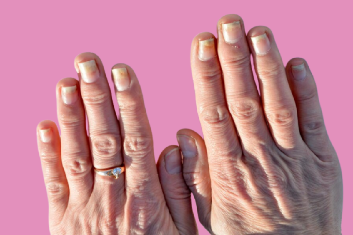 maladie ongle, ongles de terry